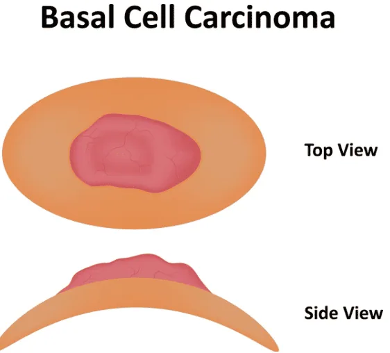 Basal Cell Carcinoma: The Most Common – and Most Treatable – Skin Cancer