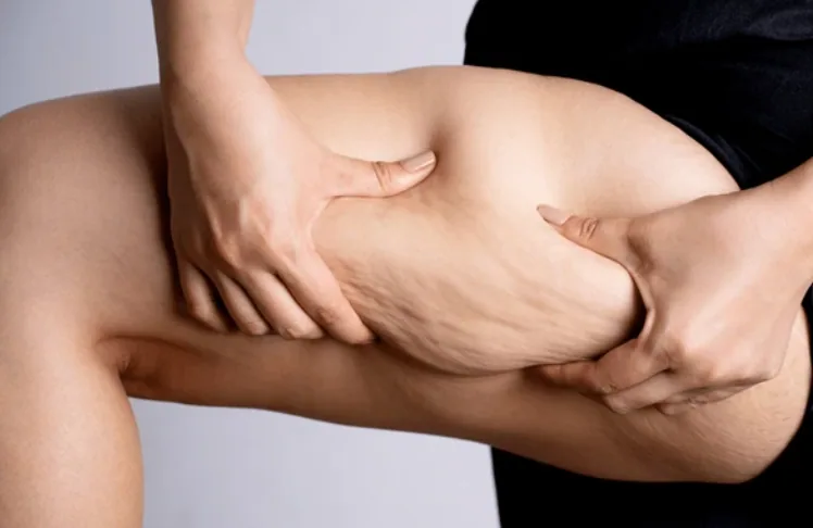 cellulite