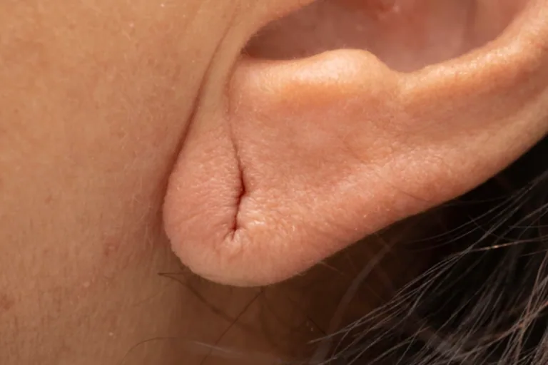 Earlobe Repair | PS Dermatology and Surgery
