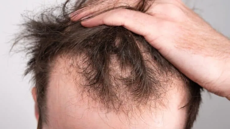 Hair Loss in Men in Bridgewater, NJ | PS Dermatology and Surgery