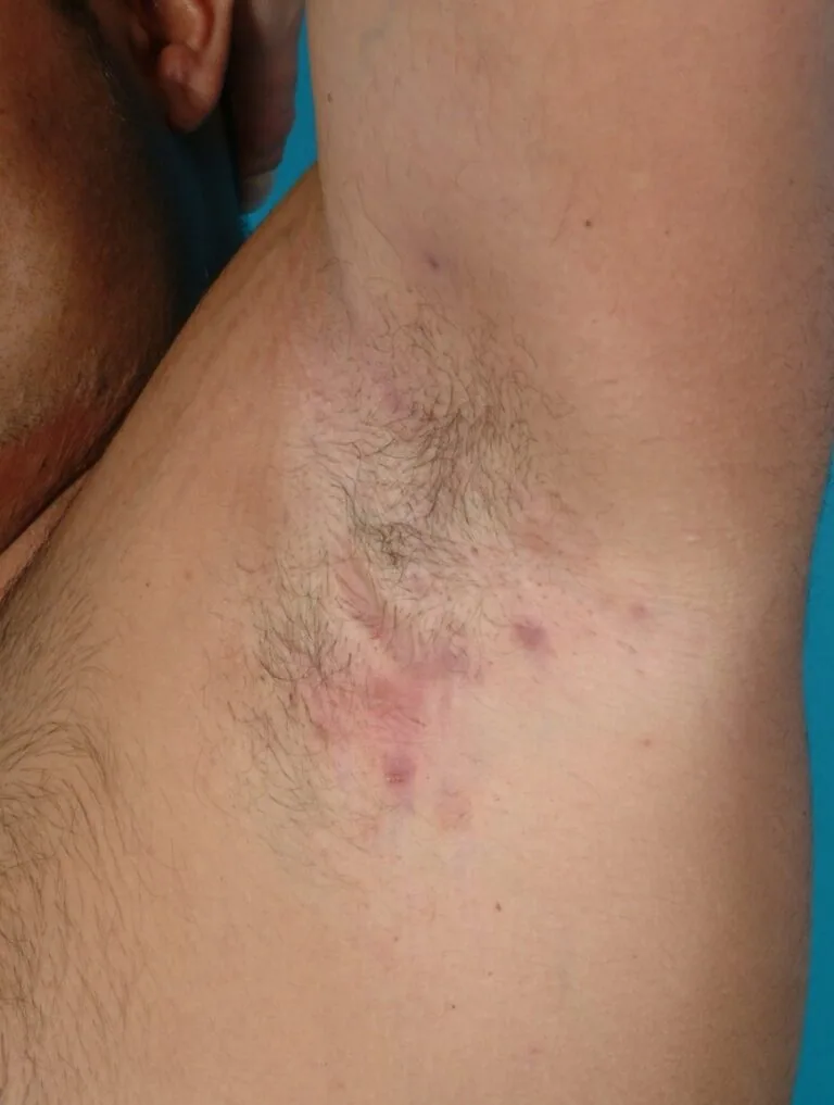 Hidradenitis suppurativa on patients armpit