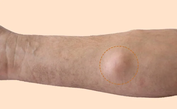 Lipoma on patients arm