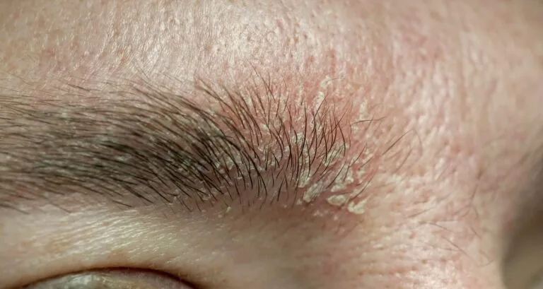 Seborrheic Dermatitis in Bridgewater, NJ | PS Dermatology and Surgery