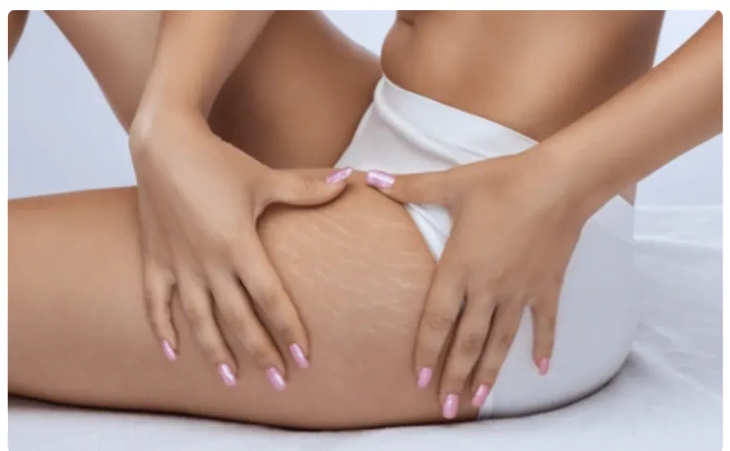 Stretch Marks | PS Dermatology and Surgery