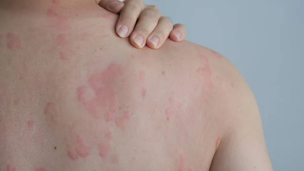 Urticaria in Bridgewater, NJ | PS Dermatology and Surgery