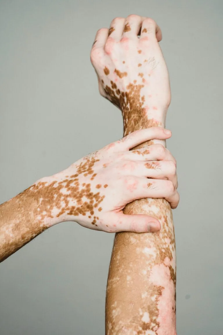 Vitiligo in Bridgewater, NJ | PS Dermatology and Surgery