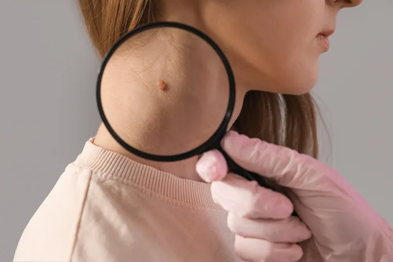 What is Skin Cancer | PS Dermatology and Surgery