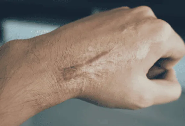 Patient with hypertrophic scar on hand